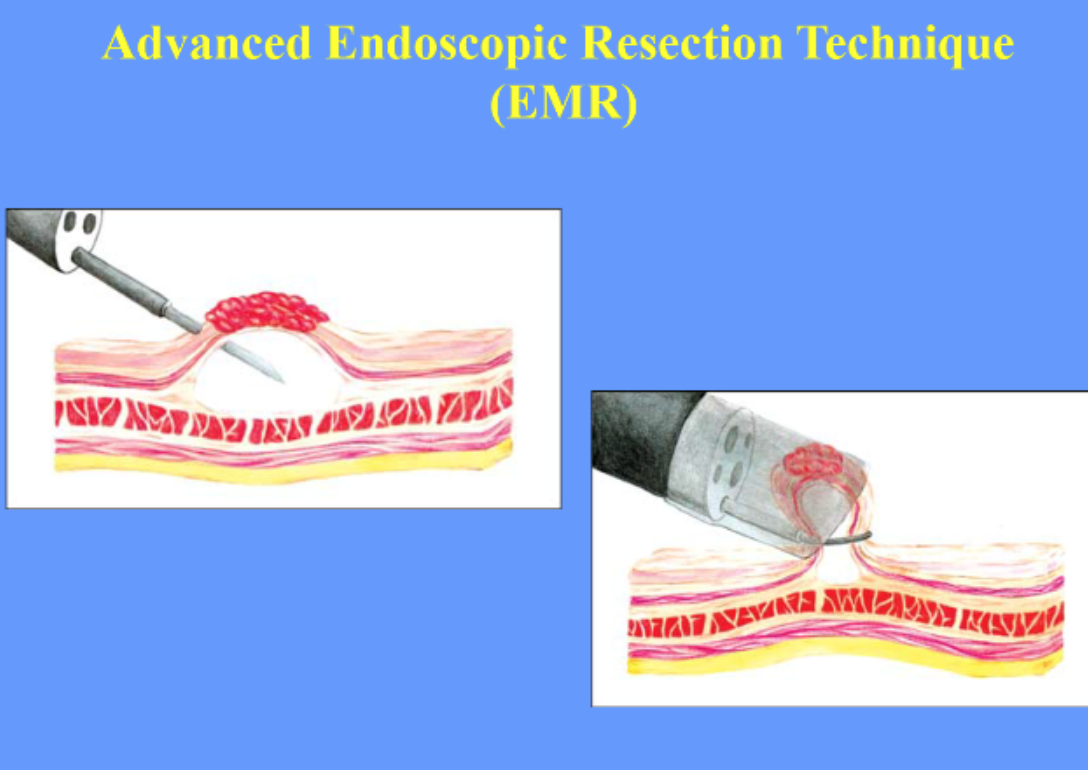 L'endoscopie interventionnelle Institut de Cancérologie Kantys